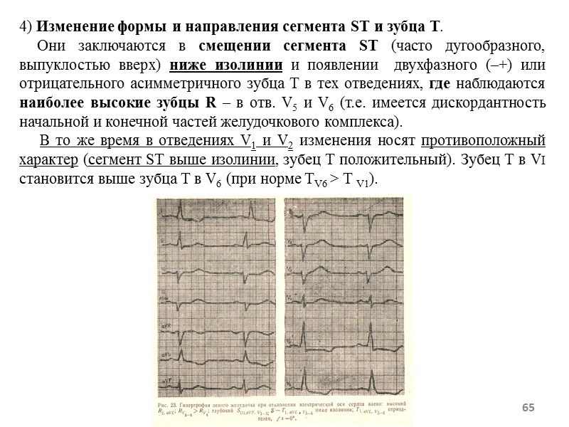 65 4) Изменение формы и направления сегмента SТ и зубца Т. 65 4) Изменение формы и направления сегмента SТ и зубца Т.